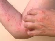 Tres casos de CHIKUNGUNYA Republica Dominicana; casos en personas que estuvieron en Cuba